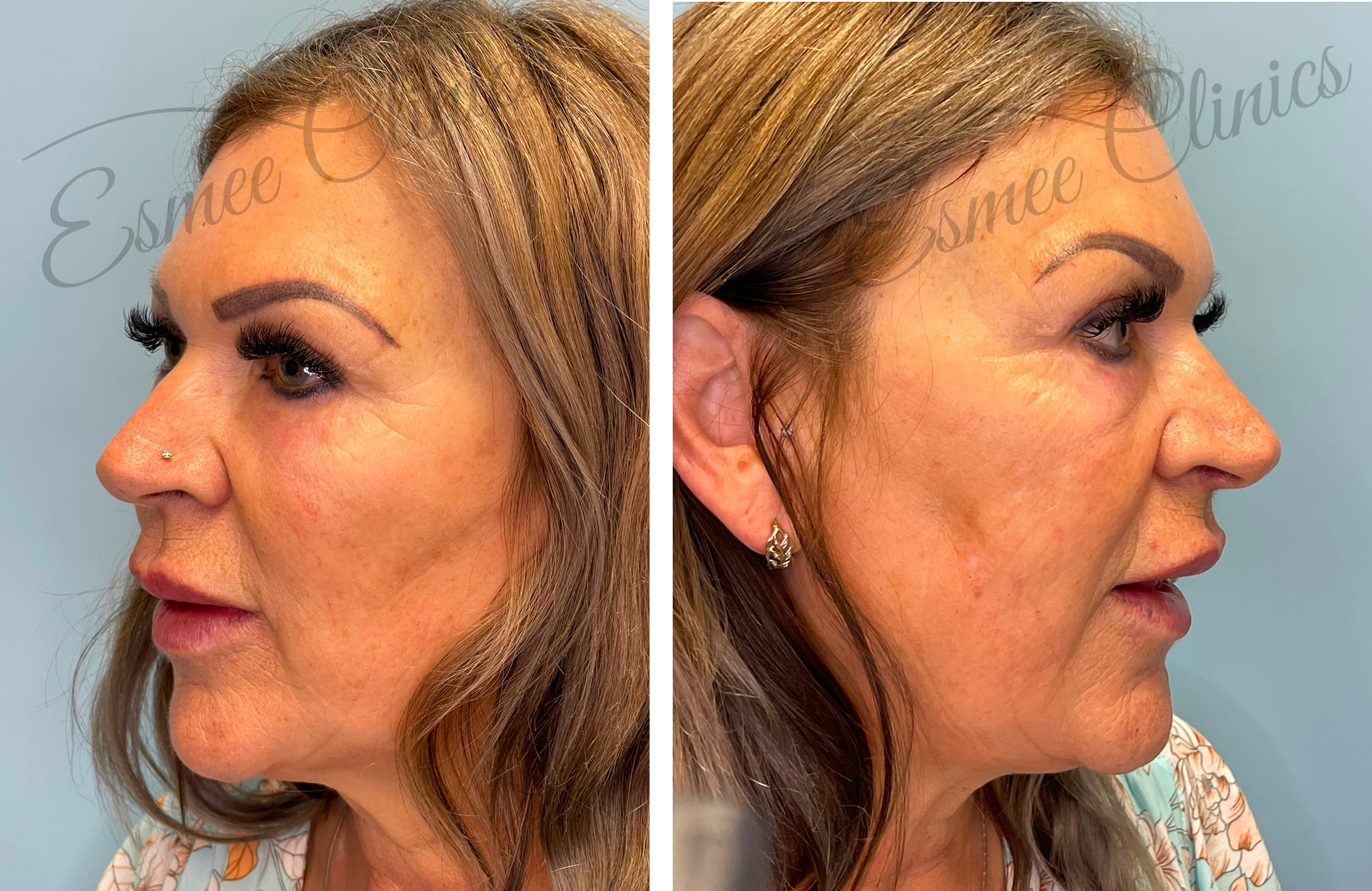 Before and After img